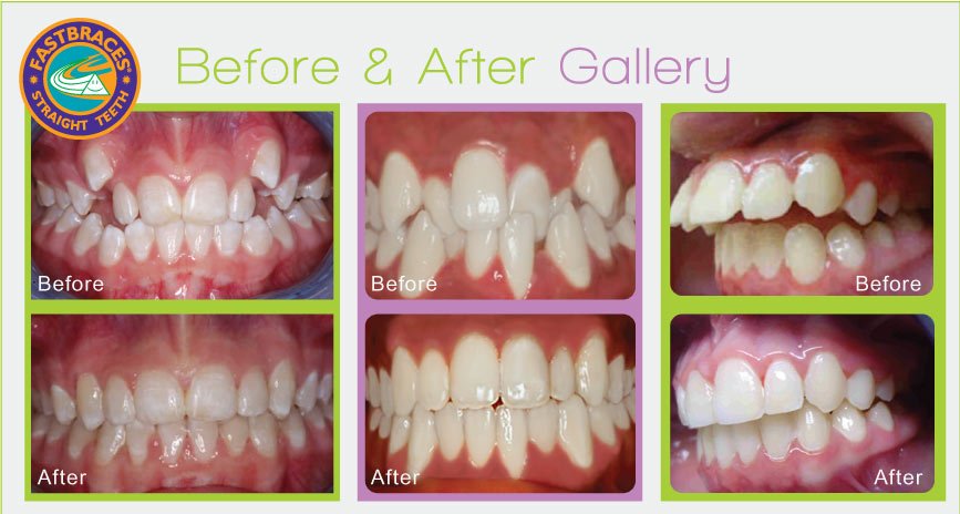 before and after fastbraces treatment in Nashville